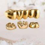 Zahngold Verkaufen und Ankauf Hannover